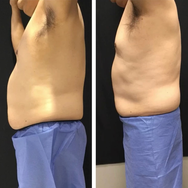 Before and After CoolSculpting at Sculpt Cypress in Cypress, TX