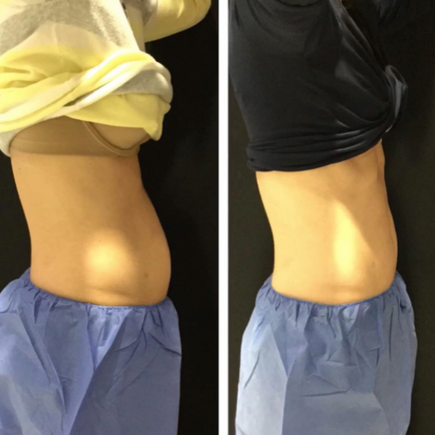 Before and After CoolSculpting at Sculpt Cypress in Cypress, TX